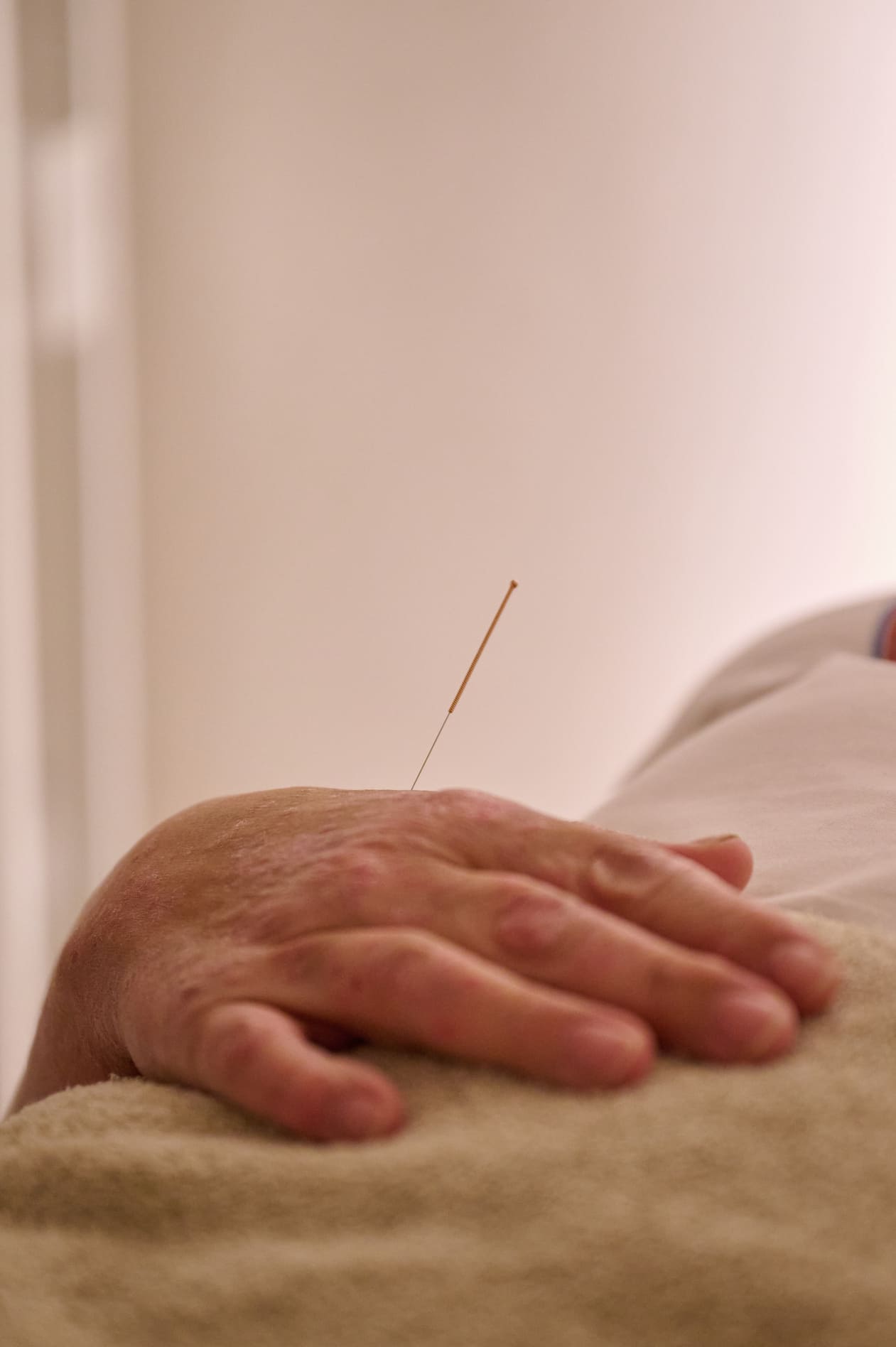 Acupuntura
